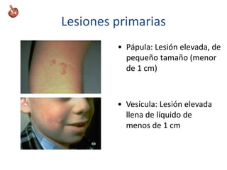 Lesiones primarias
• Pápula: Lesión elevada, de
pequeño tamaño (menor
de 1 cm)
• Vesícula: Lesión elevada
llena de líquido de
menos de 1 cm
 