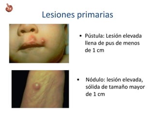 Lesiones primarias
• Pústula: Lesión elevada
llena de pus de menos
de 1 cm
• Nódulo: lesión elevada,
sólida de tamaño mayor
de 1 cm
 