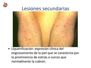 Lesiones secundarias
• Liquenificación: expresión clínica del
engrosamiento de la piel que se caracteriza por
la prominencia de estrías o surcos que
normalmente la cubren.
 