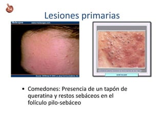 Lesiones primarias
• Comedones: Presencia de un tapón de
queratina y restos sebáceos en el
folículo pilo-sebáceo
 