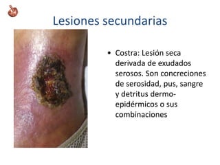 Lesiones secundarias
• Costra: Lesión seca
derivada de exudados
serosos. Son concreciones
de serosidad, pus, sangre
y detritus dermo-
epidérmicos o sus
combinaciones
 