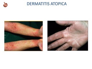 DERMATITIS ATOPICA
 