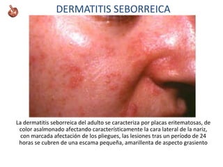 La dermatitis seborreica del adulto se caracteriza por placas eritematosas, de
color asalmonado afectando característicamente la cara lateral de la nariz,
con marcada afectación de los pliegues, las lesiones tras un período de 24
horas se cubren de una escama pequeña, amarillenta de aspecto grasiento
DERMATITIS SEBORREICA
 