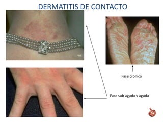 Fase sub aguda y aguda
Fase crónica
DERMATITIS DE CONTACTO
 