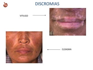 DISCROMIAS
VITILIGO
CLOASMA
 