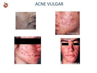 ACNE VULGAR
 