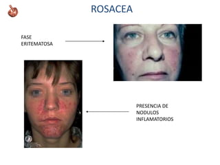 ROSACEA
FASE
ERITEMATOSA
PRESENCIA DE
NODULOS
INFLAMATORIOS
 