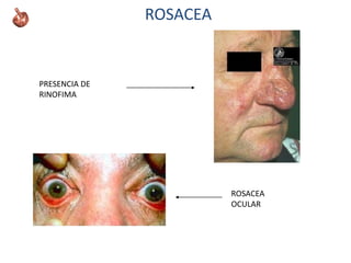 ROSACEA
PRESENCIA DE
RINOFIMA
ROSACEA
OCULAR
 