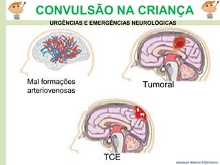 Ivanilson Ribeiro-Enfermeiro
CONVULSÃO NA CRIANÇA
TumoralMal formações
arteriovenosas
TCE
URGÊNCIAS E EMERGÊNCIAS NEUROLÓGICAS
 