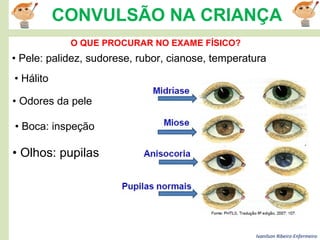 Ivanilson Ribeiro-Enfermeiro
CONVULSÃO NA CRIANÇA
O QUE PROCURAR NO EXAME FÍSICO?
• Pele: palidez, sudorese, rubor, cianose, temperatura
• Hálito
• Odores da pele
• Boca: inspeção
• Olhos: pupilas
 