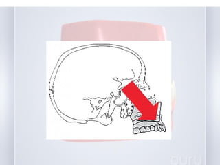 early treatment of class III malocclusion | PPT