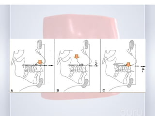 early treatment of class III malocclusion | PPT