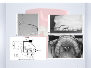 early treatment of class III malocclusion | PPT
