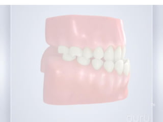early treatment of class III malocclusion | PPT