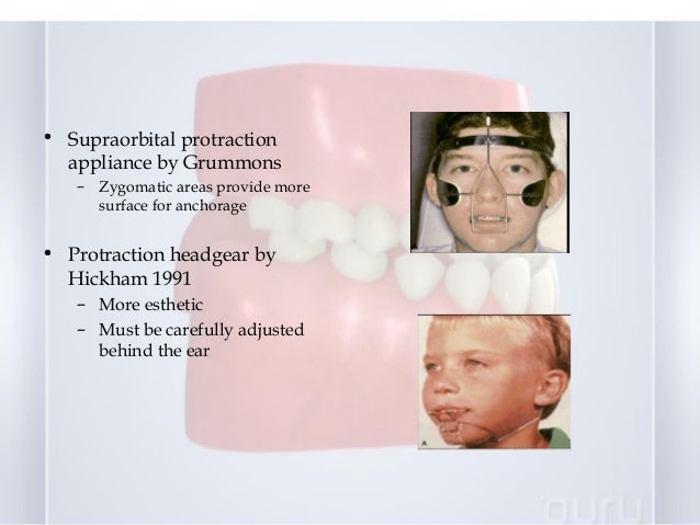Download Early Treatment Of Class Iii Malocclusion PSD Mockup Templates