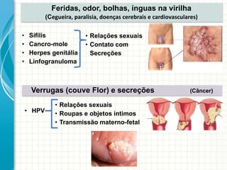 Feridas, odor, bolhas, ínguas na virilha
(Cegueira, paralisia, doenças cerebrais e cardiovasculares)
Verrugas (couve Flor) e secreções (Câncer)
• Relações sexuais
• Contato com
Secreções
• Relações sexuais
• Roupas e objetos íntimos
• Transmissão materno-fetal
• Sífilis
• Cancro-mole
• Herpes genitália
• Linfogranuloma
• HPV
 