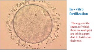 In - vitro
fertilization
The egg and the
sperm (of which
there are multiple)
are left in a petri
dish to fertilise on
their own.
 