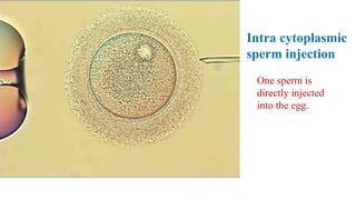 Intra cytoplasmic
sperm injection
One sperm is
directly injected
into the egg.
 