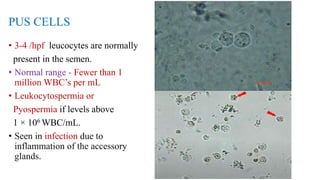 PUS CELLS
• 3-4 /hpf leucocytes are normally
present in the semen.
• Normal range - Fewer than 1
million WBC’s per mL
• Leukocytospermia or
Pyospermia if levels above
1 × 106 WBC/mL.
• Seen in infection due to
inflammation of the accessory
glands.
 