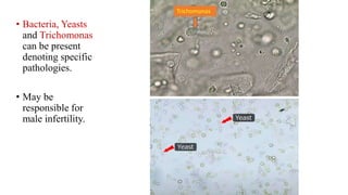 • Bacteria, Yeasts
and Trichomonas
can be present
denoting specific
pathologies.
• May be
responsible for
male infertility.
Trichomonas
 