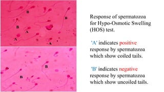Response of spermatozoa
for Hypo-Osmotic Swelling
(HOS) test.
'A' indicates positive
response by spermatozoa
which show coiled tails.
'B' indicates negative
response by spermatozoa
which show uncoiled tails.
 