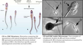 CD vs. ERC Structure. Illustration comparing (A)
spermatozoa with typical cytoplasmic droplets (CD) and
(B) spermatozoa presenting with excess residual
cytoplasm (ERC). Also listed are specific causes of
spermiogenesis arrest that can lead to ERC.
CD and ERC under Microscope. True examples of
cytoplasmic droplets (A, B) and excess residual
cytoplasm (C, D) in human spermatozoa as examined by
microscopy. © Oxford Journals.
 