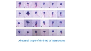 Abnormal shape of the head of spermatozoa
 