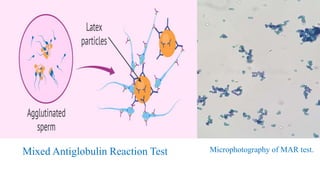 Microphotography of MAR test.Mixed Antiglobulin Reaction Test
 