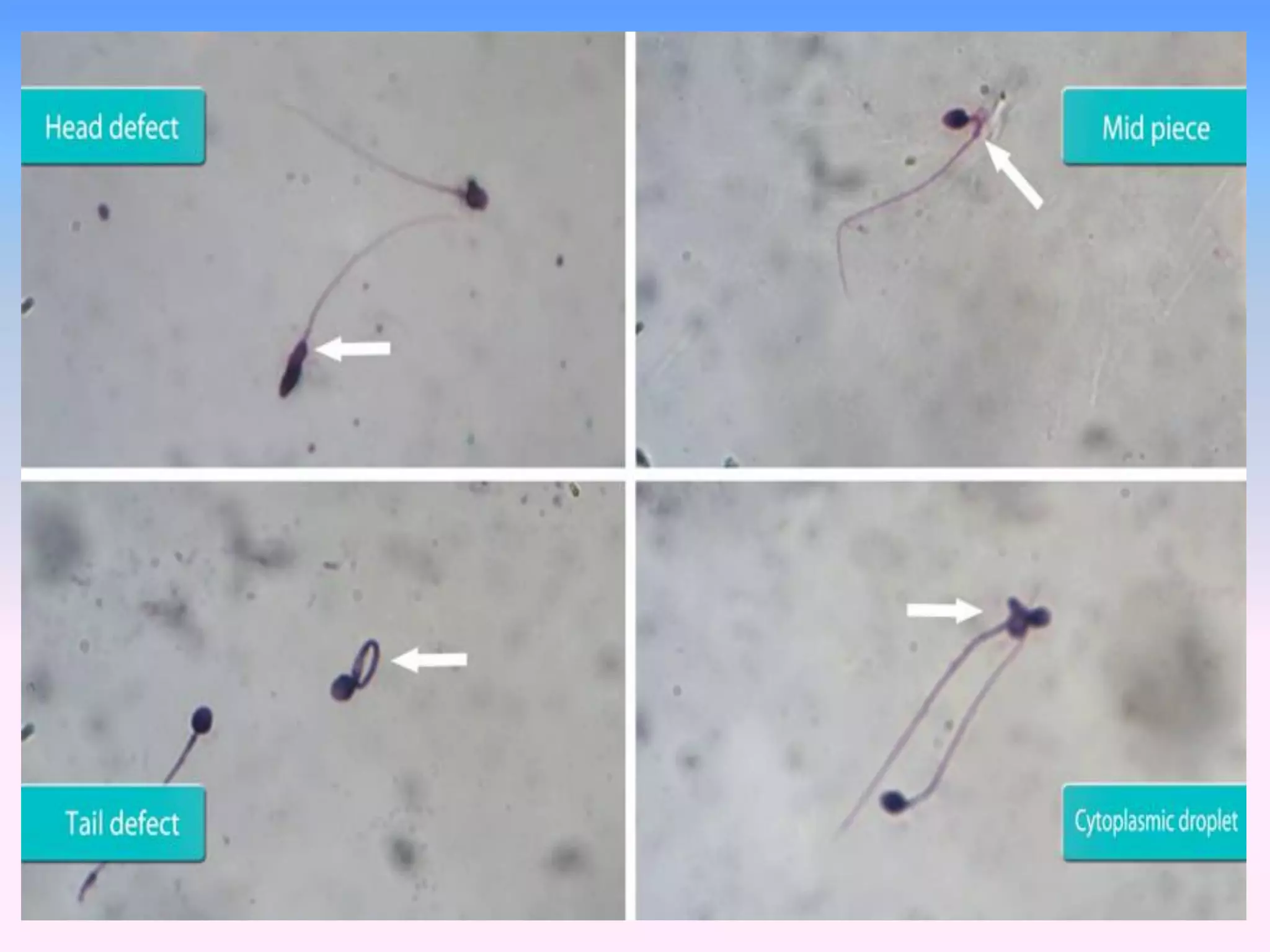 Semen Analysis Who Criteria