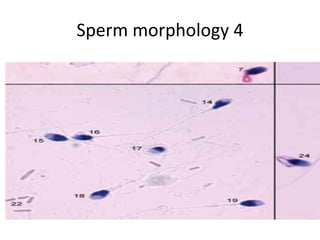 Sperm morphology 4
 