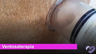 Ventosaterapia
 