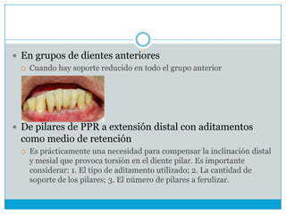  En grupos de dientes anteriores
 Cuando hay soporte reducido en todo el grupo anterior
 De pilares de PPR a extensión distal con aditamentos
como medio de retención
 Es prácticamente una necesidad para compensar la inclinación distal
y mesial que provoca torsión en el diente pilar. Es importante
considerar: 1. El tipo de aditamento utilizado; 2. La cantidad de
soporte de los pilares; 3. El número de pilares a ferulizar.
 