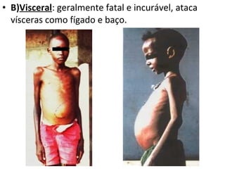• B)Visceral: geralmente fatal e incurável, ataca
vísceras como fígado e baço.
 