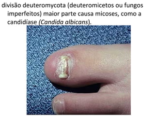 divisão deuteromycota (deuteromicetos ou fungos
imperfeitos) maior parte causa micoses, como a
candidíase (Candida albicans).
 