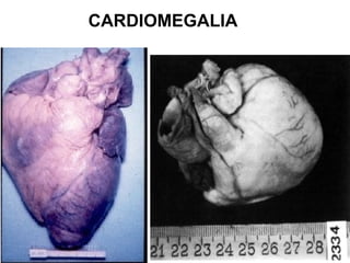 CARDIOMEGALIA
 