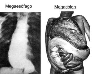 Megaesôfago Megacólon
 