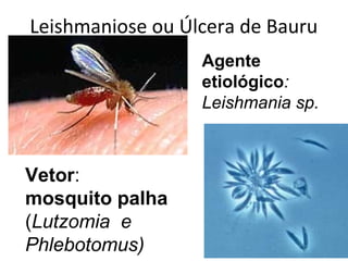 Leishmaniose ou Úlcera de Bauru
Vetor:
mosquito palha
(Lutzomia e
Phlebotomus)
Agente
etiológico:
Leishmania sp.
 