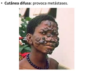 • Cutânea difusa: provoca metástases.
 