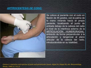 ARTROCENTESIS DE CODO:
Se coloca al paciente con el codo en
flexión de 45 grados, con la palma de
la mano mirando hacia el propio
paciente, localizando el punto de
entrada debajo de la cabeza del radio
a nivel de la interlinea externa de la
ARTICULACIÓN HUMERORADIAL,
entrando de forma perpendicular a la
articulación y tangencial al plano
articular de la cabeza del radio,
introduciéndola en su totalidad.
Canoso JJ. Aspiration and injection of joints and periarticular tissues. Kippel JH, Dieppe PA, eds. Rheumatology.
Mosby, 1998:12.1-12,12
 