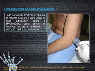 ARTROCENTESIS DE CODO: EPICONDILITIS
Codo de tenista, localizando el punto
de máximo dolor en la cara lateral de
dicha articulación sobre el
EPICONDILO, zona donde se
introduce la aguja realizando la
infiltración de forma de abanico
Canoso JJ. Aspiration and injection of joints and periarticular tissues. Kippel JH, Dieppe PA, eds. Rheumatology.
Mosby, 1998:12.1-12,12
 