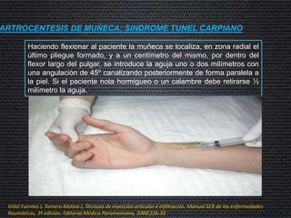 ARTROCENTESIS DE MUÑECA: SINDROME TUNEL CARPIANO
Haciendo flexionar al paciente la muñeca se localiza, en zona radial el
último pliegue formado, y a un centímetro del mismo, por dentro del
flexor largo del pulgar, se introduce la aguja uno o dos milímetros con
una angulación de 45º canalizando posteriormente de forma paralela a
la piel. Si el paciente nota hormigueo o un calambre debe retirarse ½
milímetro la aguja.
Vidal Fuentes J, Tornero Molina J, Técnicas de inyección articular e infiltración. Manual SER de las enfermedades
Reumáticas, 3ª edición. Editorial Médica Paramericana, 2000;226-33
 