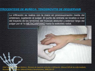 RTROCENTESIS DE MUÑECA: TENOSINOVITIS DE DEQUERVAIN
La infiltración se realiza con la mano en pronosupinación media del
antebrazo, sujetando el pulgar. El punto de entrada se localiza a nivel
del trayecto de los tendones del músculo abductor y extensor largo del
pulgar por el 1e METACARPIANO hasta la estiloides radial.
Vidal Fuentes J, Tornero Molina J, Técnicas de inyección articular e infiltración. Manual SER de las enfermedades
Reumáticas, 3ª edición. Editorial Médica Paramericana, 2000;226-33
 