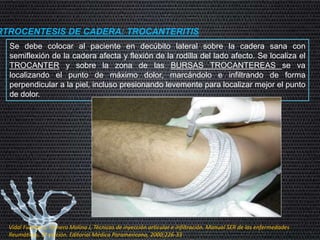 RTROCENTESIS DE CADERA: TROCANTERITIS
Se debe colocar al paciente en decúbito lateral sobre la cadera sana con
semiflexión de la cadera afecta y flexión de la rodilla del lado afecto. Se localiza el
TROCANTER y sobre la zona de las BURSAS TROCANTEREAS se va
localizando el punto de máximo dolor, marcándolo e infiltrando de forma
perpendicular a la piel, incluso presionando levemente para localizar mejor el punto
de dolor.
Vidal Fuentes J, Tornero Molina J, Técnicas de inyección articular e infiltración. Manual SER de las enfermedades
Reumáticas, 3ª edición. Editorial Médica Paramericana, 2000;226-33
 
