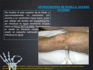 ARTROCENTESIS DE RODILLA: ACCESO
EXTERNO
Se localiza el polo superior de la rótula, y
aproximadamente un centímetro por
encima y un centímetro hacia fuera, punto
por debajo del tendón del CUADRICEPS,
se introduce la aguja levemente dirigida
hacia el POLO ROTULIANO. Normalmente
si existe un derrame moderado suele
existir un pequeño sobresalto donde se
introduce la aguja
Vidal Fuentes J, Tornero Molina J, Técnicas de inyección articular e infiltración. Manual SER de las enfermedades
Reumáticas, 3ª edición. Editorial Médica Paramericana, 2000;226-33
 