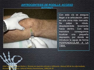 ARTROCENTESIS DE RODILLA: ACCESO
INTERNO
Con esta vía se asegura
llegar a la articulación, pero
es una zona más inervada.
Se palpa la rótula,
desplazándola levemente
hacia dentro. Con esta
maniobra conseguimos
localizar una pequeña
depresión, por donde se
introduce la aguja de forma
PERPENDICULAR A LA
TIBIA.
Vidal Fuentes J, Tornero Molina J, Técnicas de inyección articular e infiltración. Manual SER de las enfermedades
Reumáticas, 3ª edición. Editorial Médica Paramericana, 2000;226-33
 