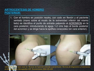 ARTROCENTESIS DE HOMBRO
POSTERIOR:
1. Con el hombro en posición neutra, con codo en flexión y el paciente
sentado (mano sobre el muslo de la extremidad inferior del mismo
lado) se identifica el punto de entrada palpando el ACROMION en la
cara posterior, introduciendo la aguja 1-2 cms bajo el borde posterior
del acromion y se dirige hacia la apófisis coracoides (en cara anterior).
Judez Navarro E, Jover Jover JA. Técnicas de inyección articular y periarticular. Técnicas de diagnostico y tratamiento
en Reumatología. Monografías SER. Paramericana 2004:195-202
 