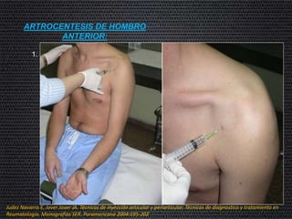 ARTROCENTESIS DE HOMBRO
ANTERIOR:
1. Posición neutra y el codo flexionado 90º con la palma mirando hacia si
mismo, se puede localizar la articulación glenohumeral colocando uno
de los dedos entre la apófisis coracoides y cabeza humeral. A medida
que el brazo se desplaza en rotación interna, puede apreciarse que la
cabeza humeral gira hacia dentro y el espacio articular puede
apreciarse en forma de un surco inmediatamente por fuera de la
coracoides. La aguja se dirige perpendicularmente y ligeramente hacia
arriba al interior articular.
Judez Navarro E, Jover Jover JA. Técnicas de inyección articular y periarticular. Técnicas de diagnostico y tratamiento en
Reumatología. Monografías SER. Paramericana 2004:195-202
 