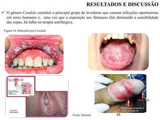 16
 O gênero Candida constitui o principal grupo de leveduras que causam infecções oportunistas
em seres humanos e, uma vez que a exposição aos fármacos têm diminuído a sensibilidade
das cepas, há falha na terapia antifúngica.
RESULTADOS E DISCUSSÃO
Figura 14. Infecções por Candida
Fonte: Internet
 