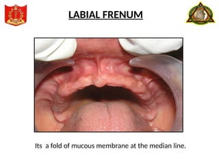 Its a fold of mucous membrane at the median line.
LABIAL FRENUM
 