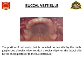 The portion of oral cavity that is bounded on one side by the teeth,
gingiva and alveolar ridge (residual alveolar ridge) on the lateral side
by the cheek posterior to the buccal frenum”
BUCCAL VESTIBULE
 